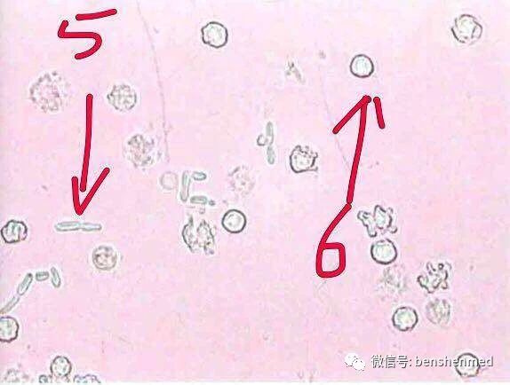 图中5:为酵母样真菌（多半是白色念珠菌） 图中6：为尿中红细胞形态