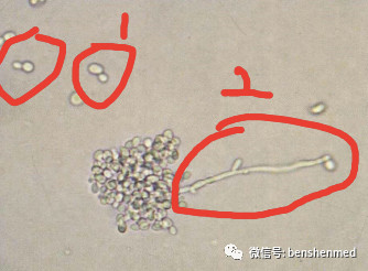 酵母样真菌孢子1、假菌丝2