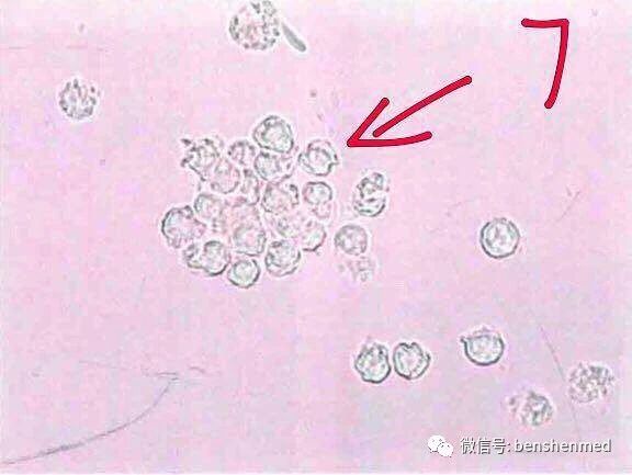 图中7:为尿中成团的白细胞