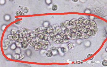 白细胞管型