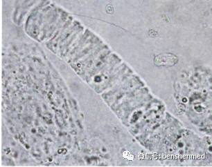 腊样管型