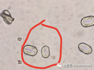 草酸钙结晶